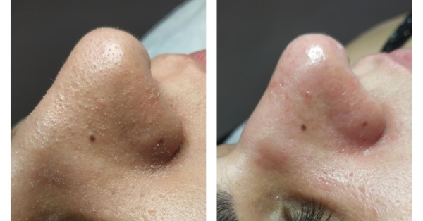 Limpeza de pele detox