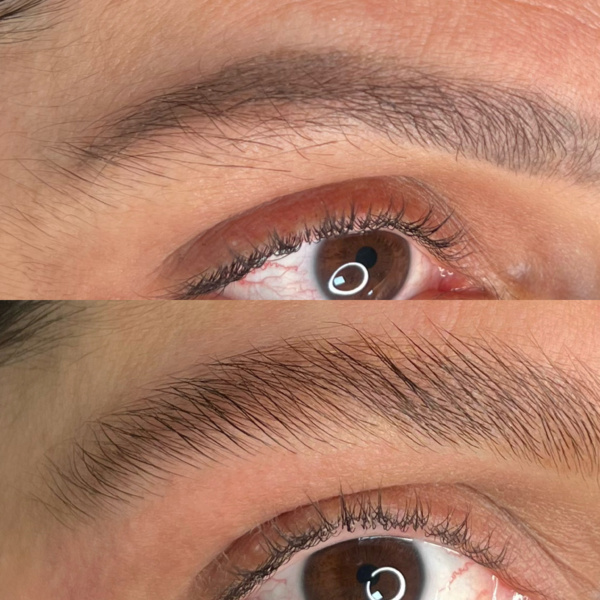 remoçao de micropigmentacao a laser