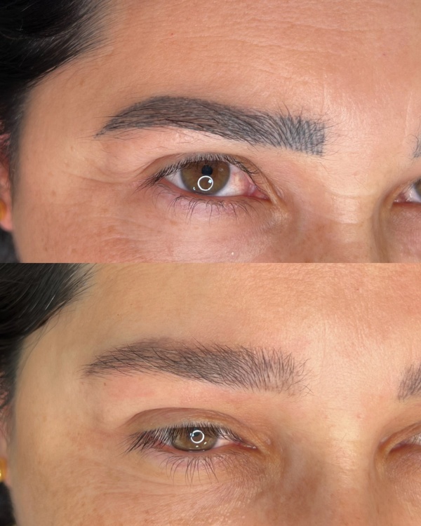 remoçao de micropigmentacao a laser
