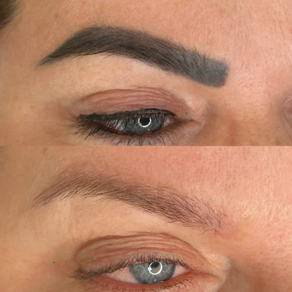 remoçao de micropigmentacao a laser
